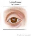 Can Cataracts Be Healed Naturally?