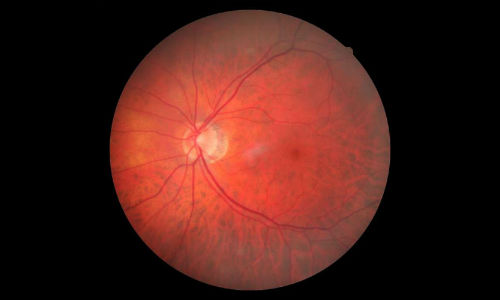 retinal detachment