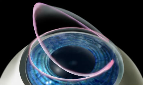 Can You Still Improve Your Vision Naturally After LASIK?