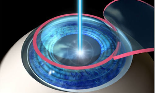 What Everybody Should Know Before Getting LASIK